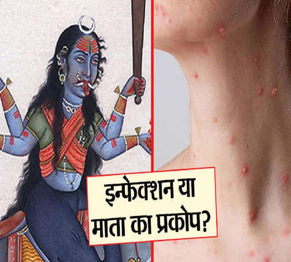 Do you know the reason why Chicken Pox called Mata in india
