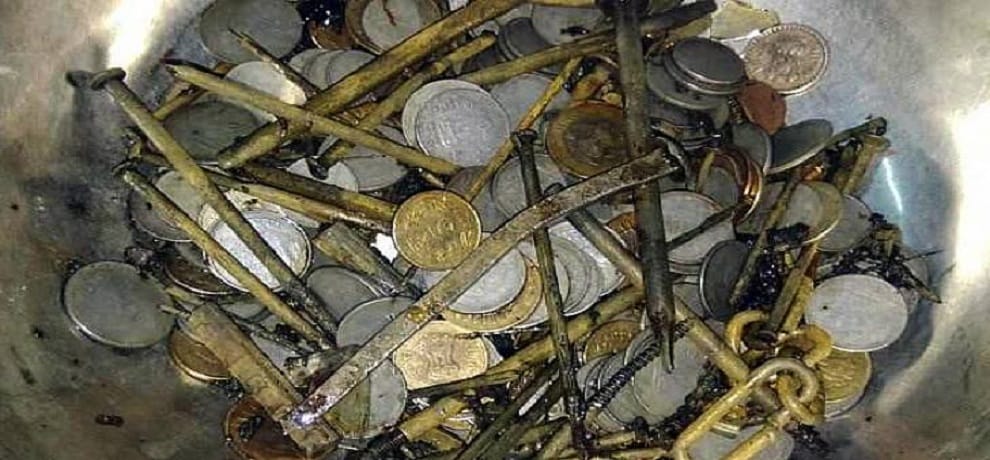 In Palghar district of Maharashtra Doctors Remove 72 Coins From a person's stomach