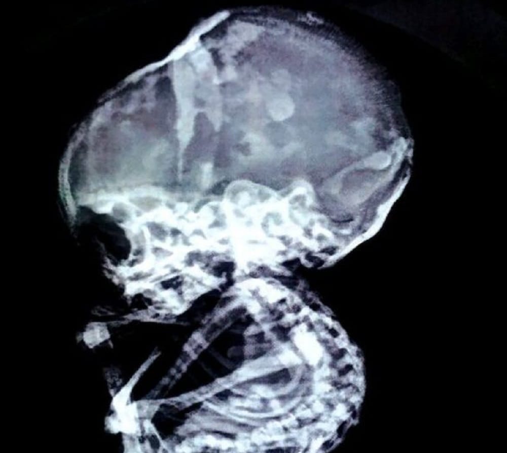 Stone Baby Found In Women Abdomen At Nagpur 15 Years After Abortion