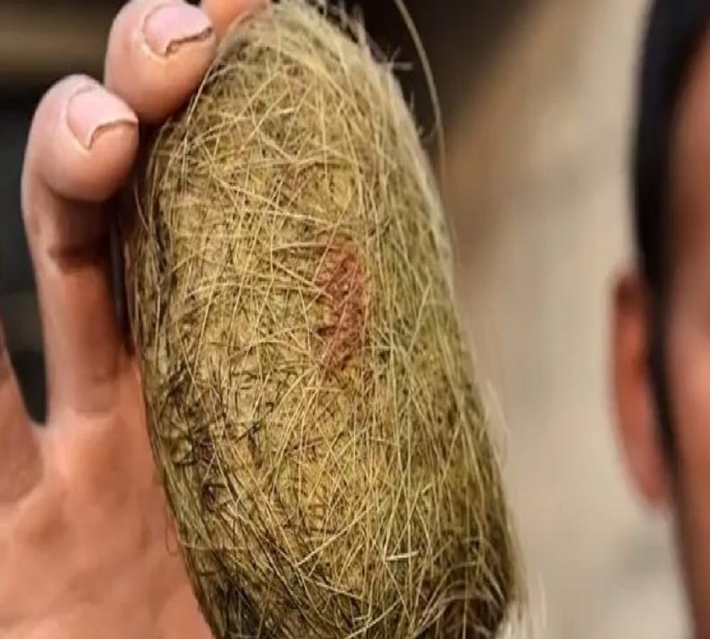 A man found Millionaire making stone from pig stomach at china