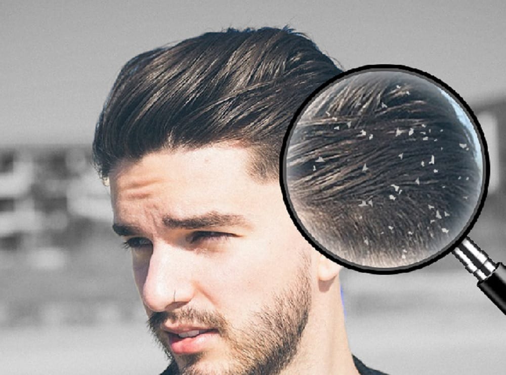 it is not a secret now get rid Of Dandruff Permanently with this easy solution