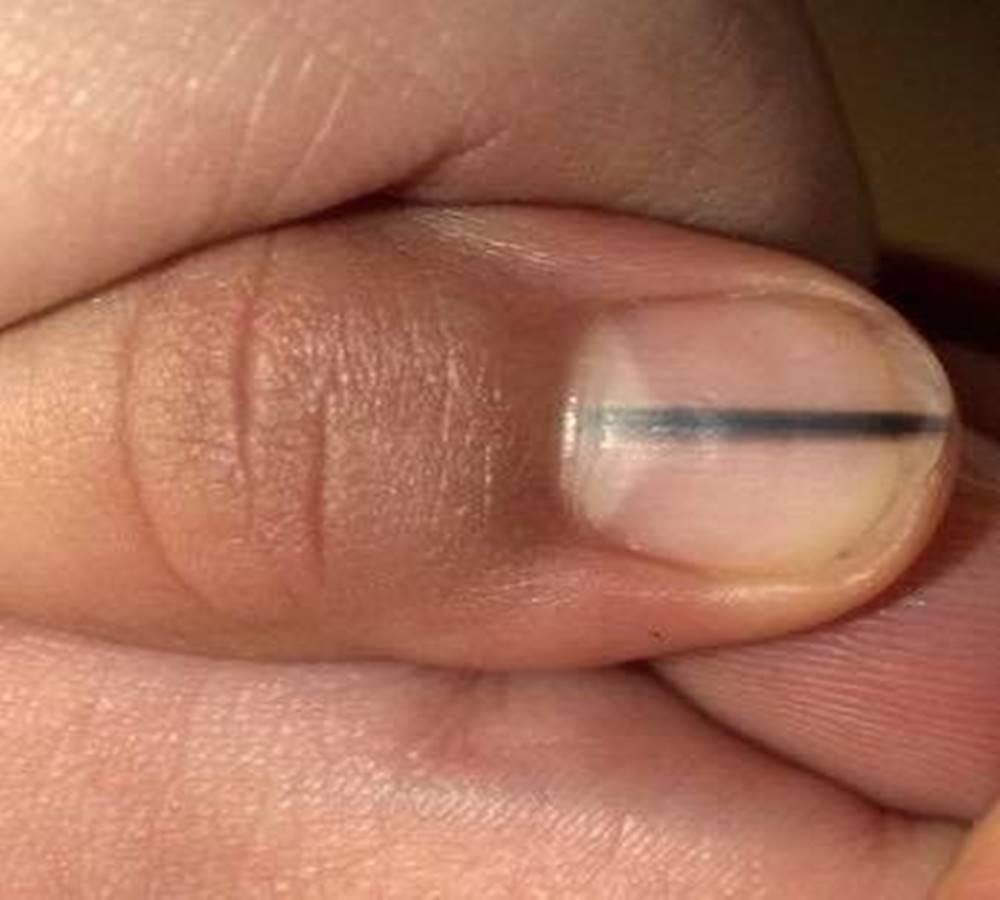 There are some signs in your nails that tells you may be in danger