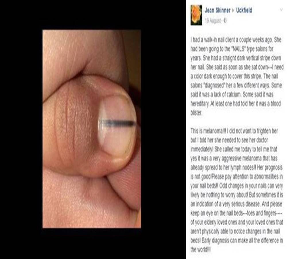 There are some signs in your nails that tells you may be in danger