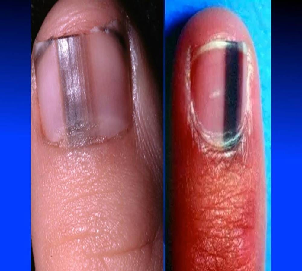 Nail biting is bad for your health