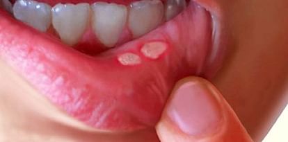 Mouth Ulcers 