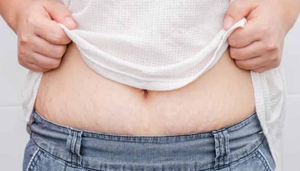 These magical tips can vanish your stretch marks with in few days