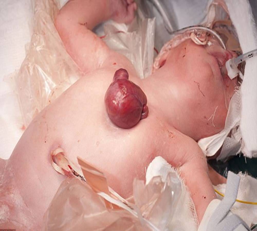 The New Born Baby Heart was beating out of the Chest
