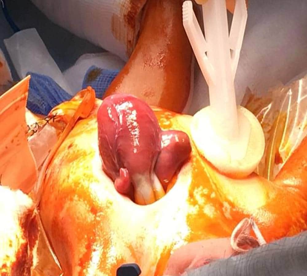 The New Born Baby Heart was beating out of the Chest