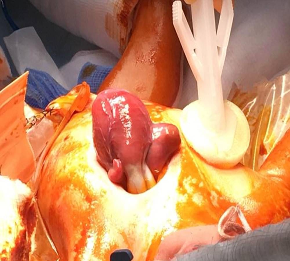 The New Born Baby Heart was beating out of the Chest