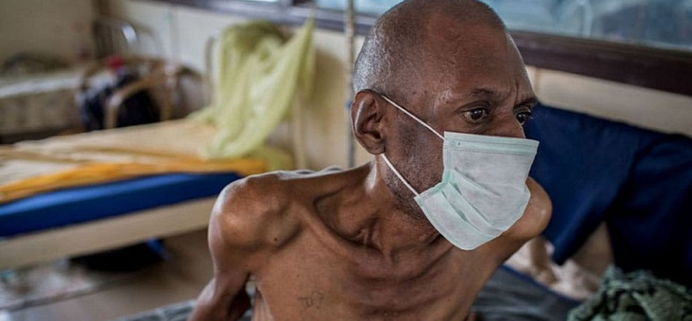 17 million TB patients identified in 2018