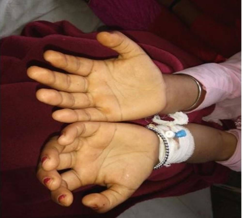 A Mysterious Snake Bite the girl thirty four times