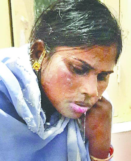 Two women scorched in acid attack in Pithoragarh