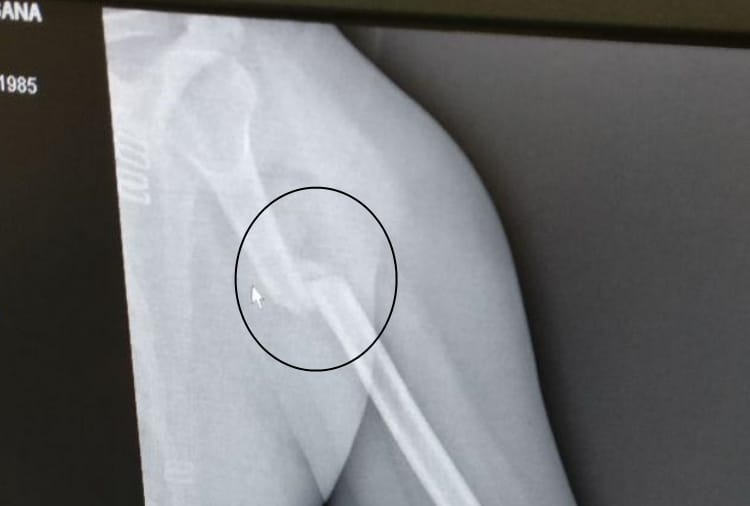 Bones will be joint without plaster  in kgmu