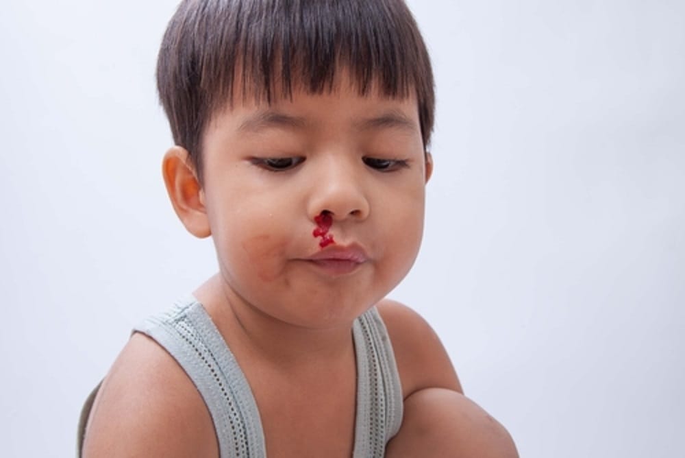 know about Nasopharyngeal angiofibroma