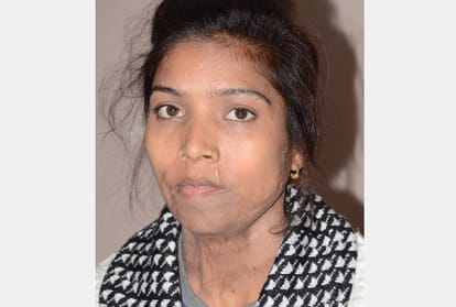 struggle and pain of acid attack victims