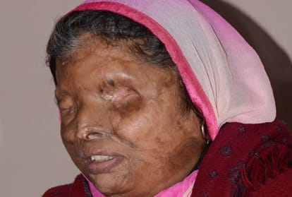 struggle and pain of acid attack victims