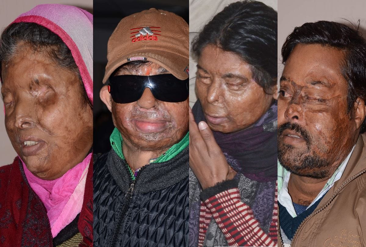 struggle and pain of acid attack victims