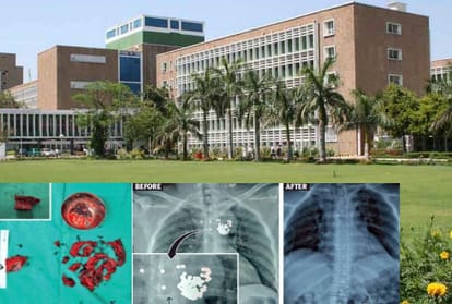 aiims doctors operated a man who was having 97 pellets in his chest for 4 years