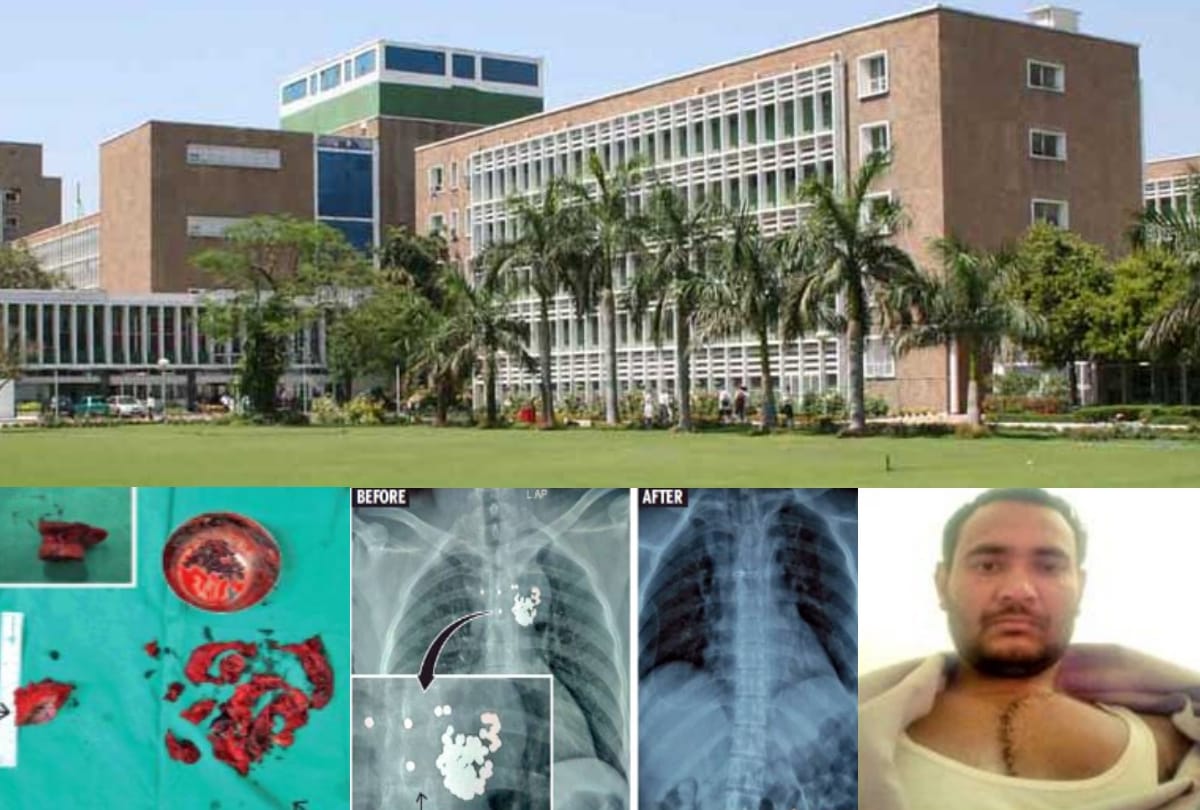 aiims doctors operated a man who was having 97 pellets in his chest for 4 years