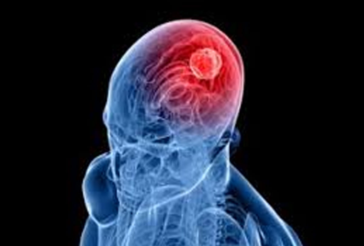 Causes of heart attack cases due to cold