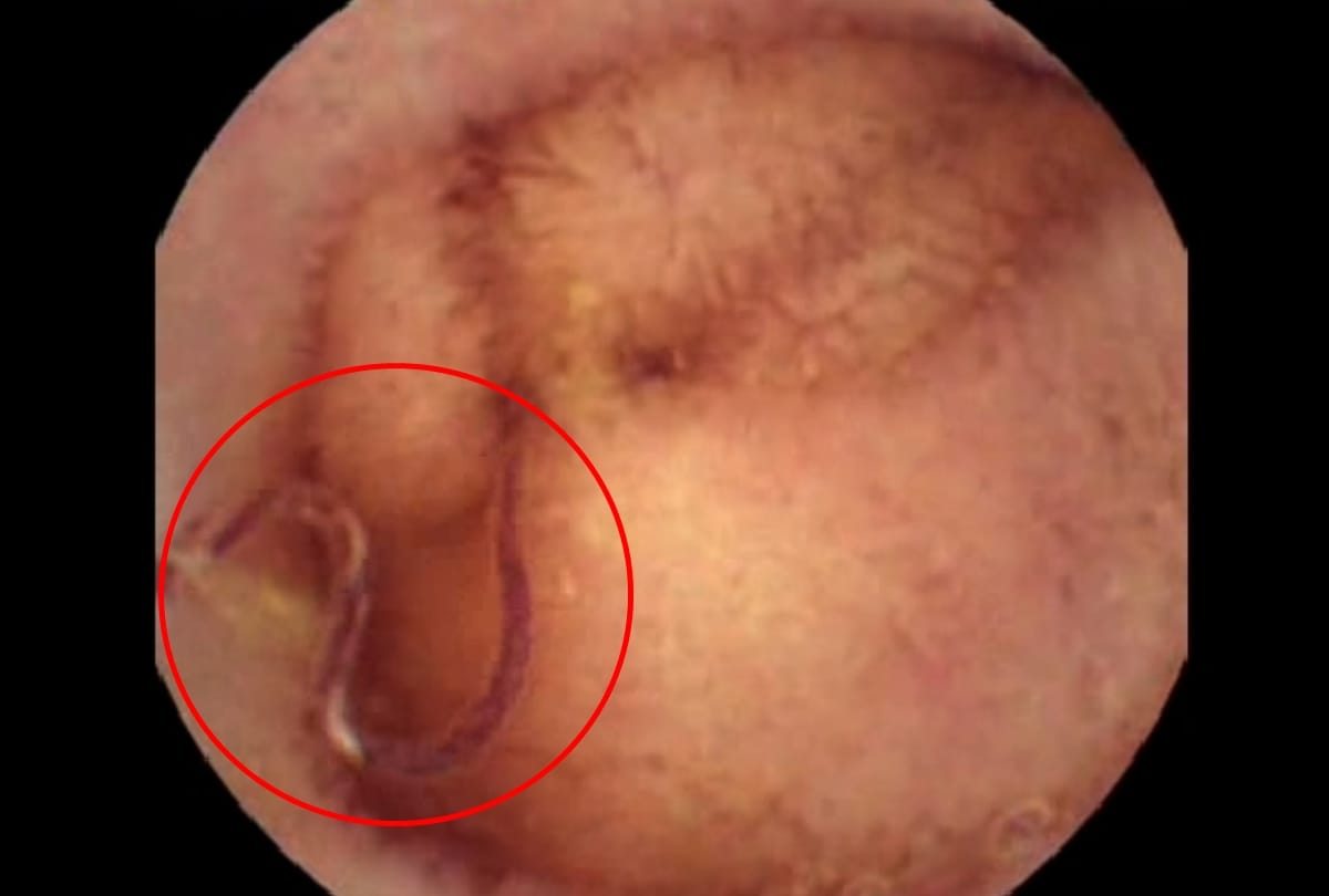 hookworm drains 22 litre of blood in two years from 14 year old boy body in delhi