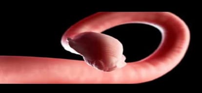 22 liters blood Suck in stomach worms in two years
