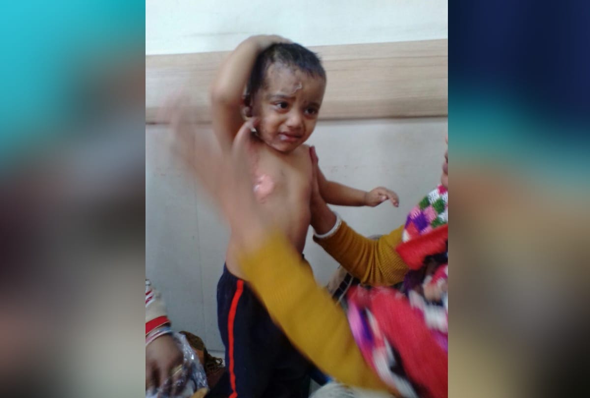 doctor returned child who was burnt by oil while cooking