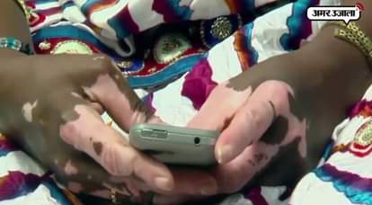 DRDO DEVELOPS MEDICINE TO TREAT VITILIGO