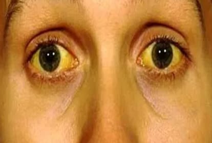 first death due to jaundice in himachal this year