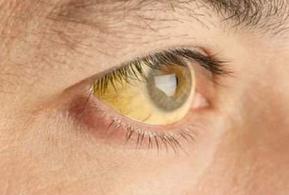 पीलिया होने के क्या कारण हैं?