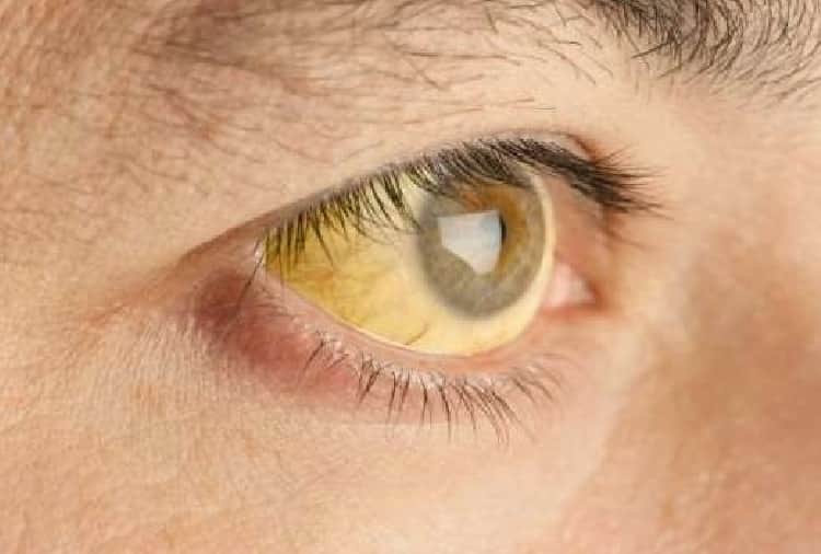 liver damage early symptoms in hindi, jaundice and loss of appetite sign of liver damage