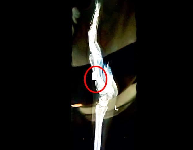 gun bullet found in ludhiana girl finger