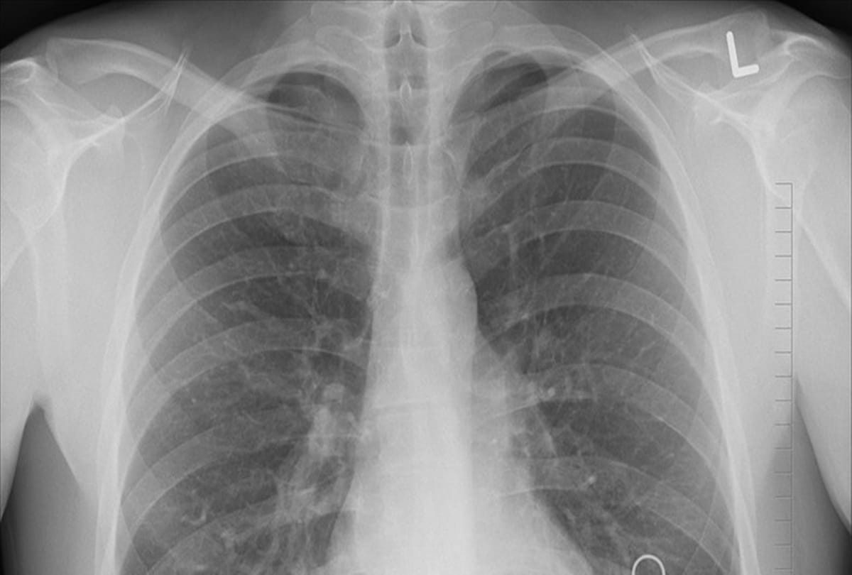 after severe coughing women suffer broken rib