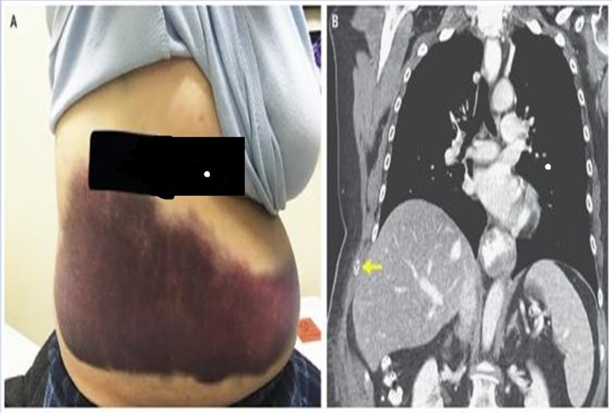 after severe coughing women suffer broken rib