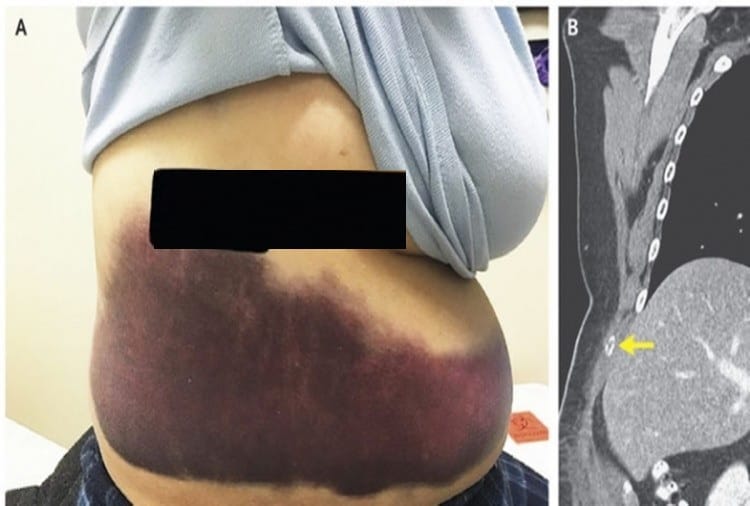 after severe coughing women suffer broken rib