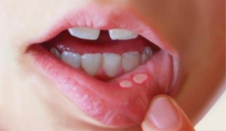 Reason Behind Mouth Ulcer And Tips To Cure Them