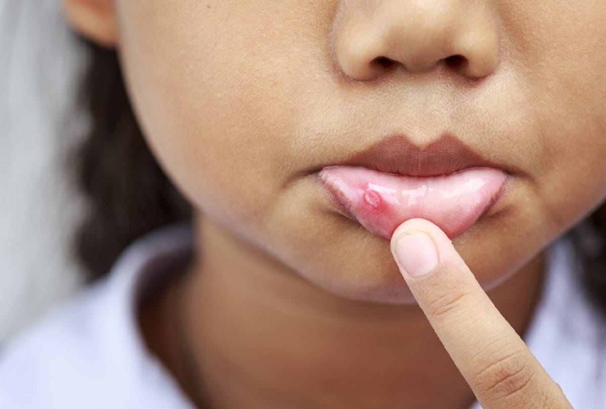 mouth ulcers treatment medicine