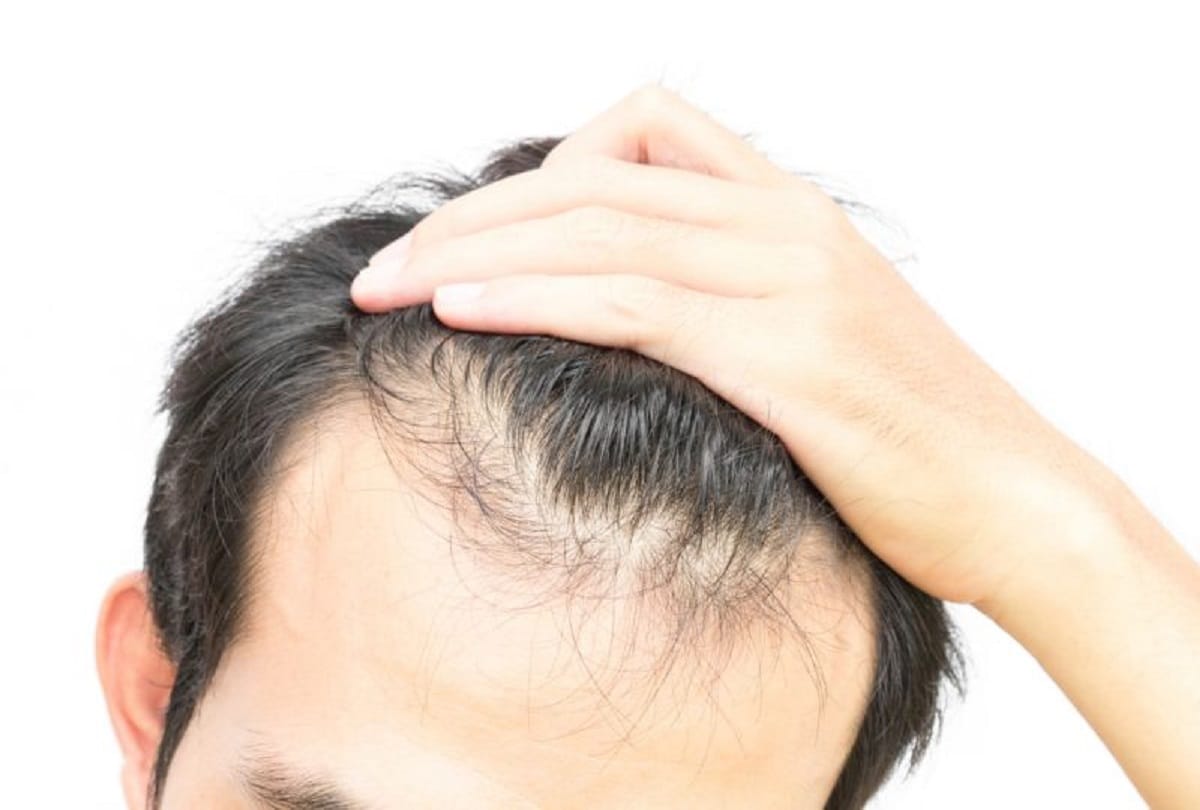 home remedies and therepy to reduce hair fall and baldness