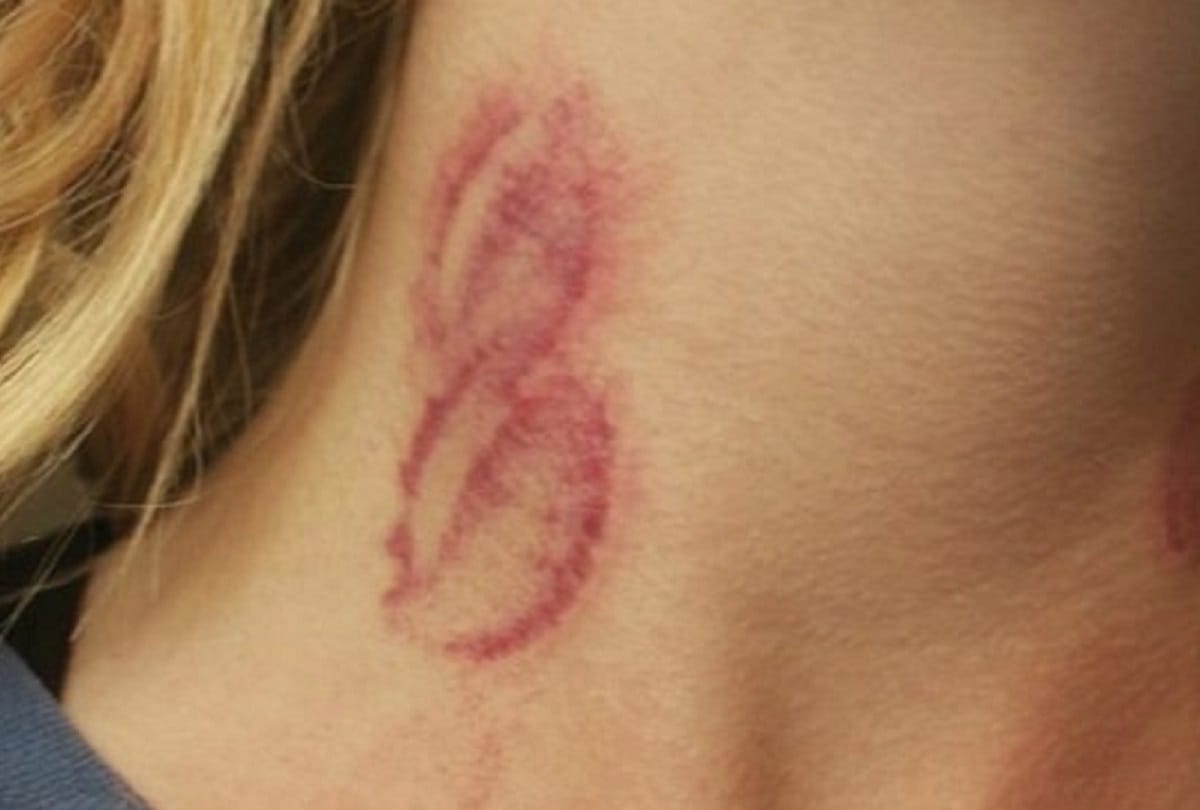 Harmful Effects Of Love Bites Or Hickey