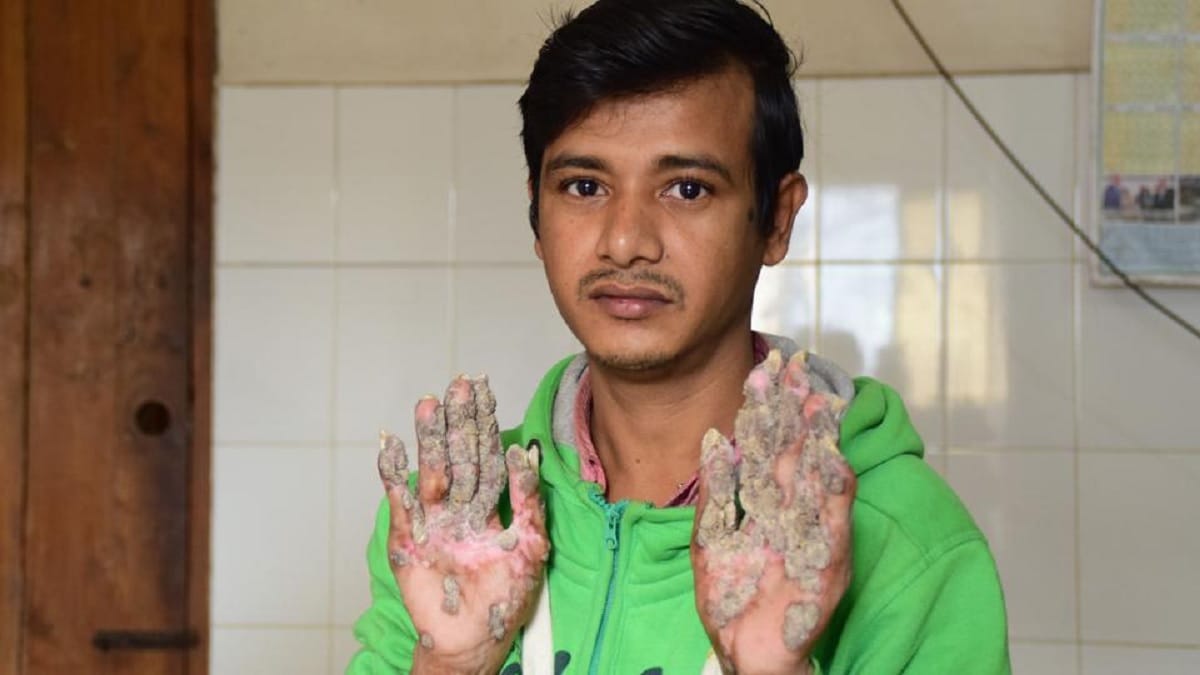 bangladesh's 'tree man' returns for more surgery after rare condition