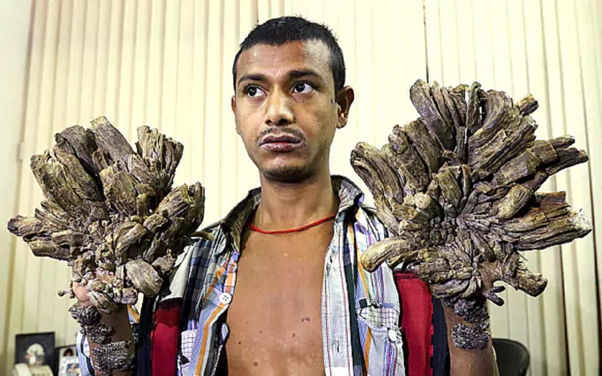Bangladesh's 'Tree Man' wants to cut hand to get relief from pain