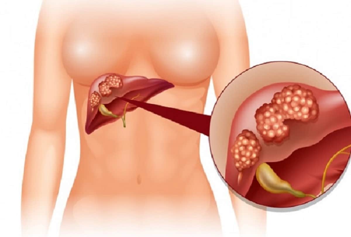 How does obesity cause liver damage or cirrhosis, know its causes and prevention in hindi