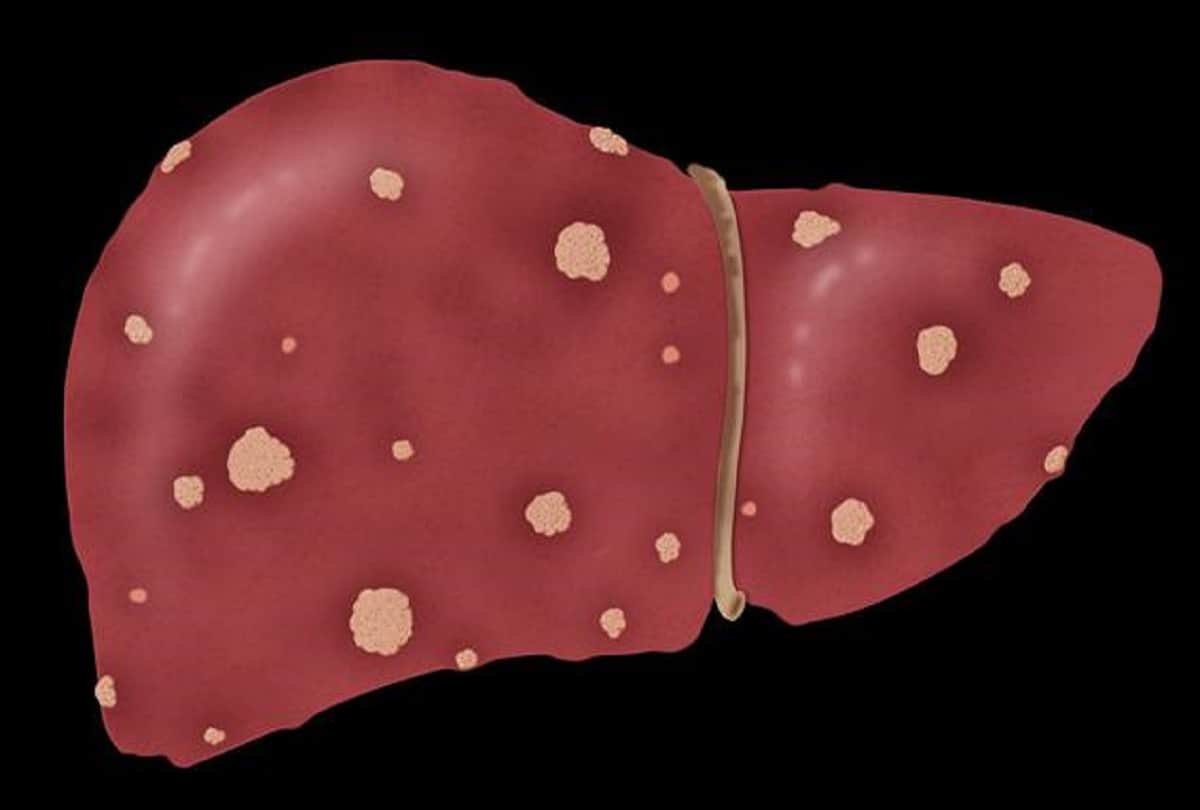 Pigs Can Now Develop An Extra Liver In Lymph Nodes; New health research says no need to liver transplant in human