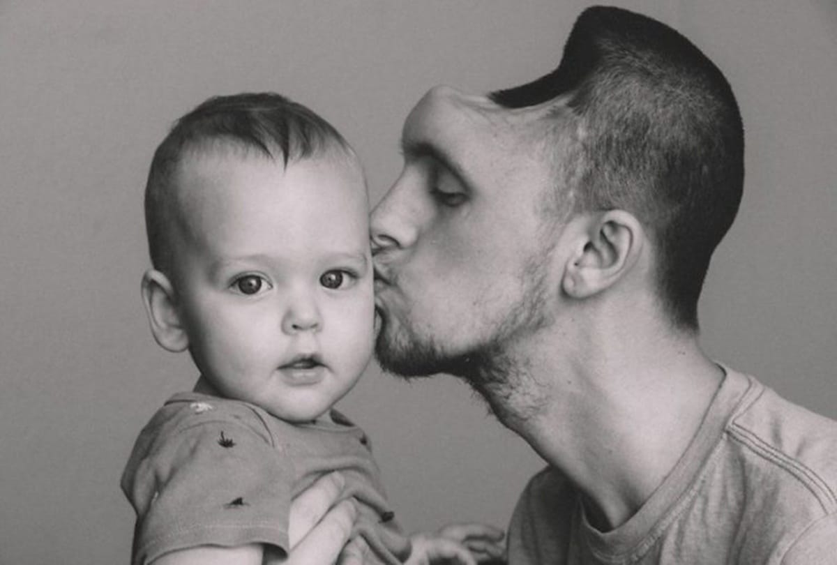 Wife shares touching story of husband who gets hole in skull after overdrinking energy drinks