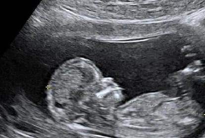doctor not authorized for ultrasound in fetus gender investigation case