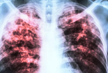 himachal govt implimented chief minister tuberculosis elimination scheme