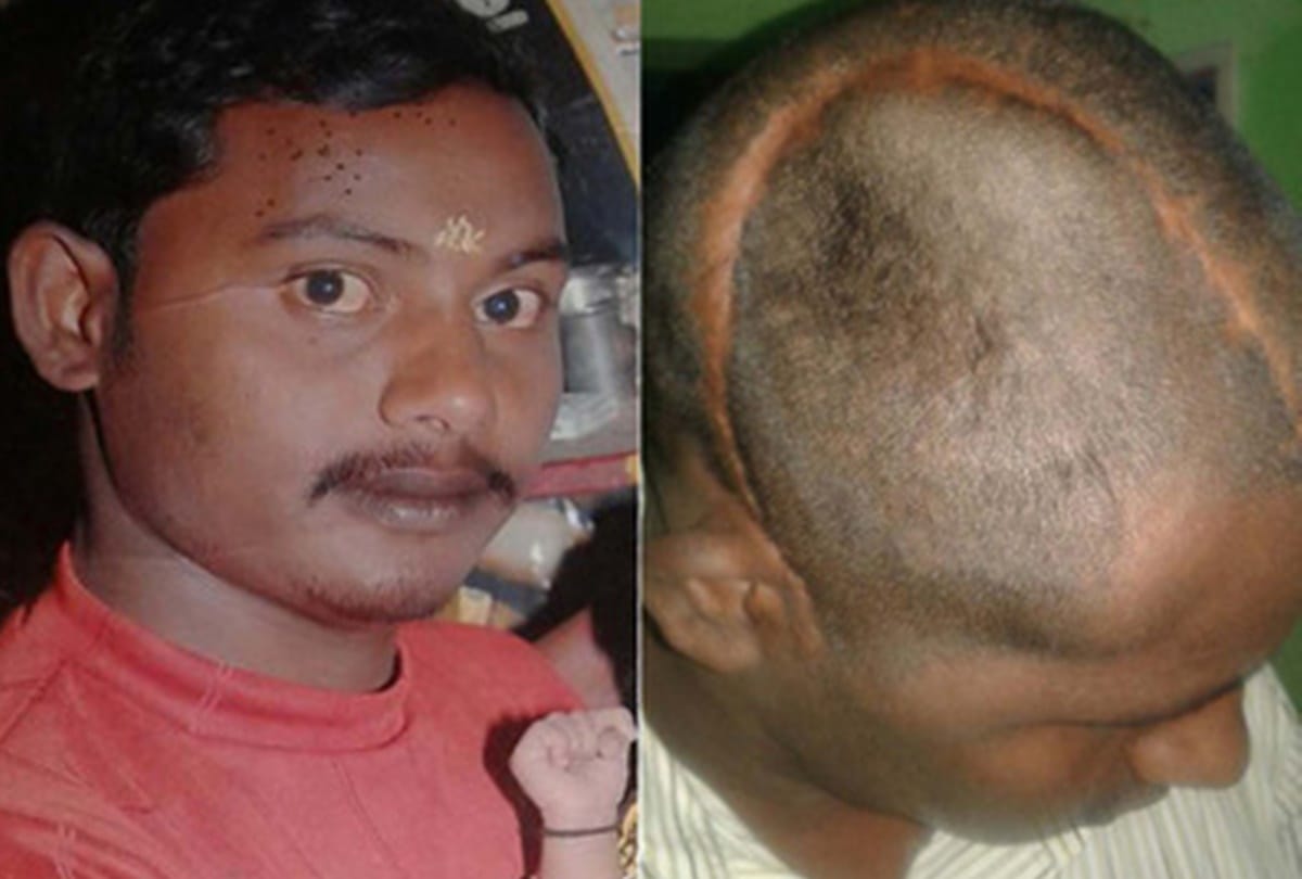 due to doctors negligence part of patients skull is missing