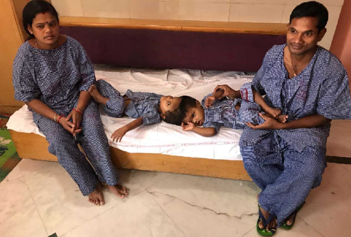 aiims 125 doctors daily practice on 3d head before separation of odisha brothers attach from head