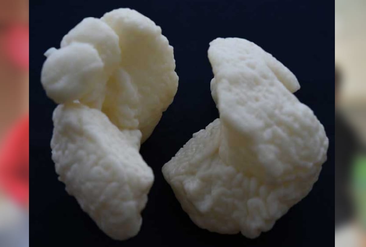 aiims 125 doctors daily practice on 3d head before separation of odisha brothers attach from head