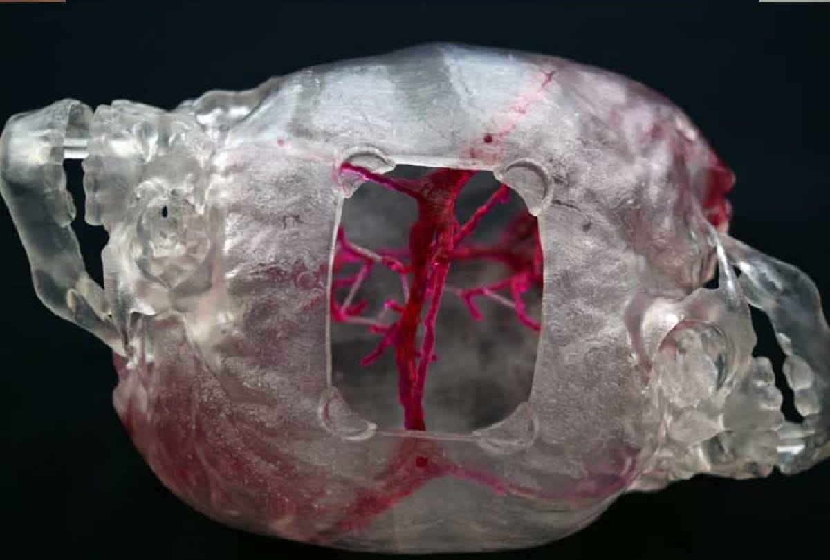 aiims 125 doctors daily practice on 3d head before separation of odisha brothers attach from head
